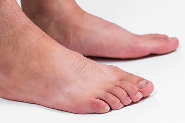 一到冬天,易出现脚后跟干裂?如何缓解?