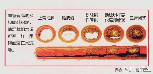 没有高血压就不会脑中风?医生辟谣:脑中风和这些因素有关