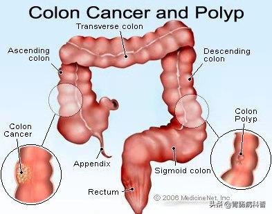 肠息肉会癌变，为什么会长肠息肉？有没有办法预防？
