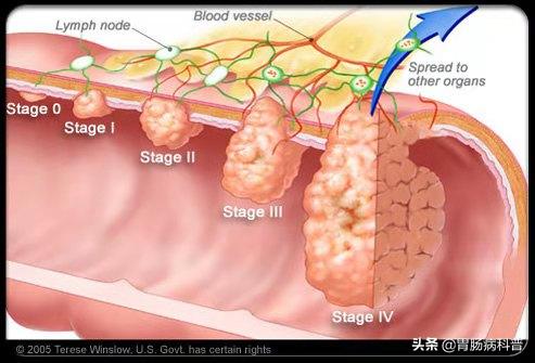 肠息肉会癌变，为什么会长肠息肉？有没有办法预防？