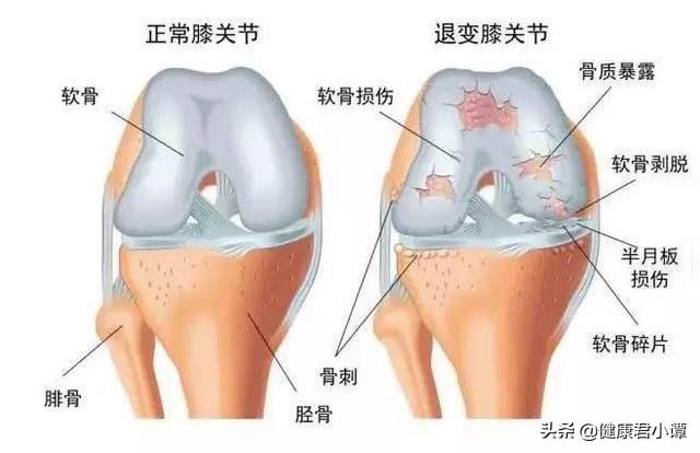 关节炎为什么痛在在你身上,而不是别人身上