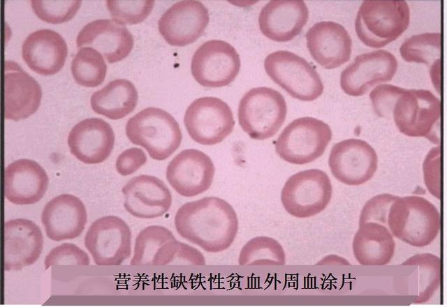 为什么缺铁性贫血那么多?那是没选对补铁食物。这3样补铁最好