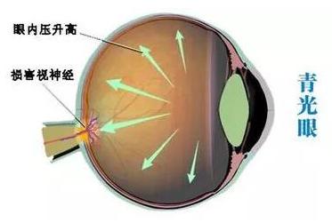 青光眼患者在“吃”上要格外注意