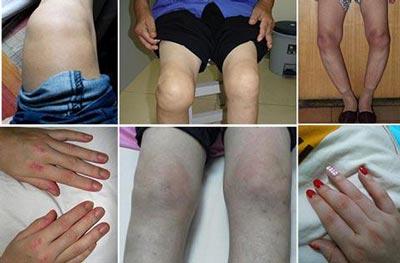 哪些方式能够防止风湿性关节炎病情恶化?