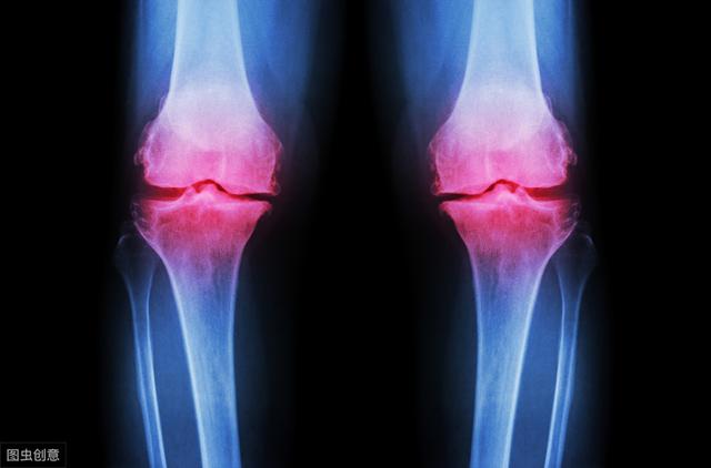 骨性关节炎的防治和误区