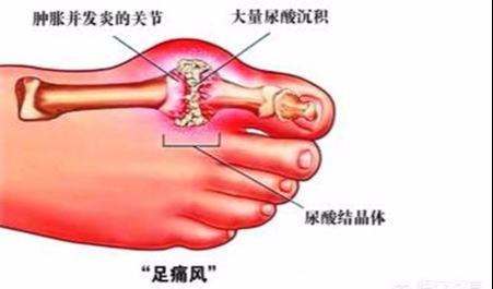 体内尿酸过高，这4种食物是大忌，否则痛风一直好不了