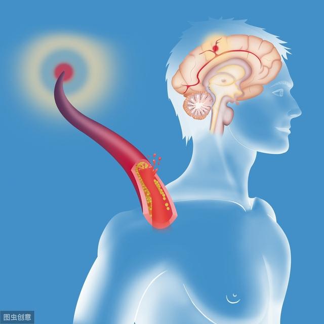 大面积脑梗死、反复癫痫发作,病因却在颈部:颈动脉粥样硬化狭窄