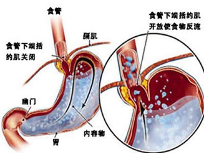 胃食管反流的症状多变?怎么判断胃食管反流?医生:看对科室很关键