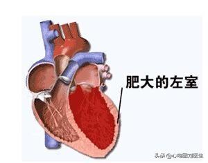 高血压最可怕的11个并发症，管理好血压是最好的预防方法。