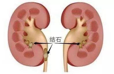年纪轻轻为什么会得肾结石?