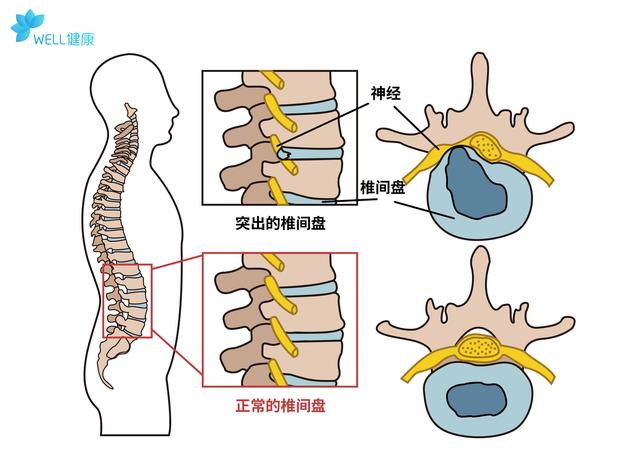 18岁就腰突了，腰突症会随着年龄增加而加剧吗？