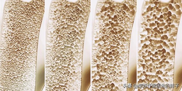年龄大了就容易腰痛、腿疼,有些老人还容易骨折,这是为什么呢