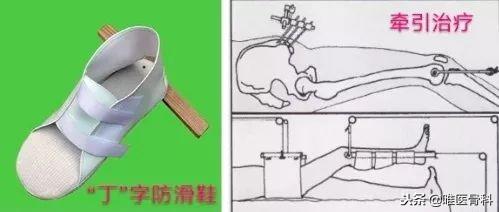 这是老年人最怕的骨折,一定要重视!