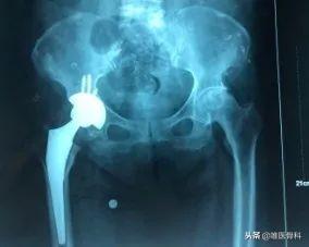 这是老年人最怕的骨折,一定要重视!