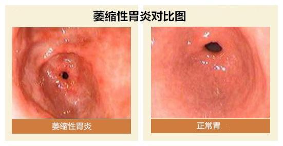辟谣!萎缩性胃炎一定会变成胃癌?大多数人都搞错了