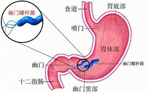 辟谣!萎缩性胃炎一定会变成胃癌?大多数人都搞错了
