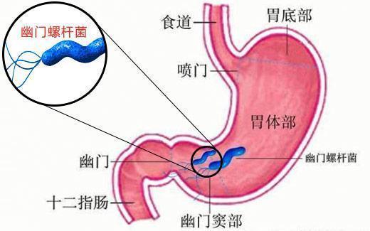 辟谣！萎缩性胃炎一定会变成胃癌？大多数人都搞错了