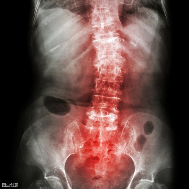 风湿免疫科常见病：青春闪了腰之强直性脊柱炎