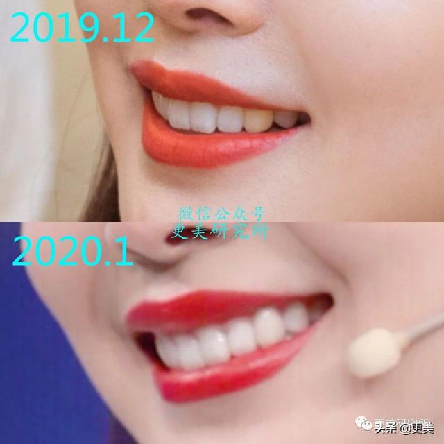 爆红30天后宋轶就去动了牙,怎么灵气就变了?