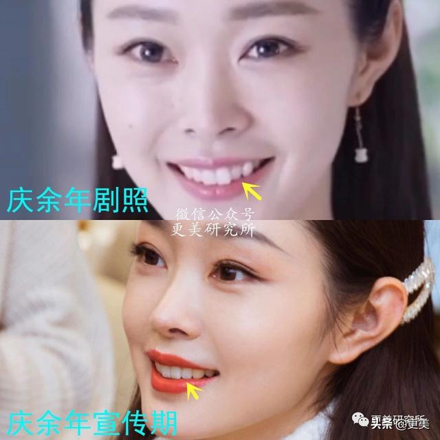 爆红30天后宋轶就去动了牙,怎么灵气就变了?