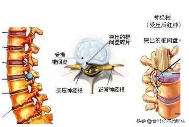 70%的颈椎病疼痛患者,盲目相信按摩,连类型都没搞清楚