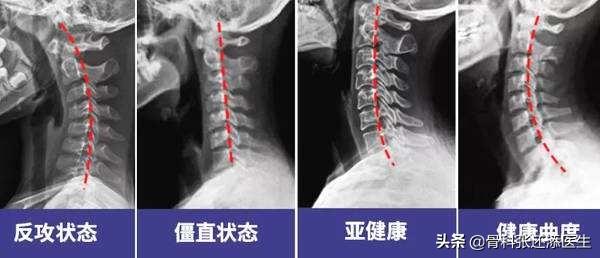 70%的颈椎病疼痛患者,盲目相信按摩,连类型都没搞清楚
