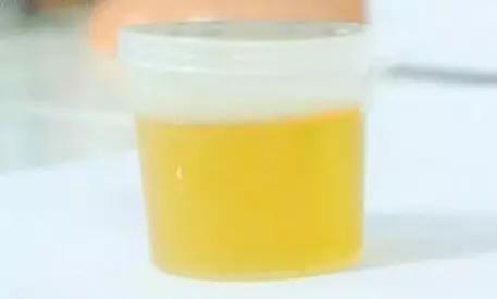 酒精肝和脂肪肝有什么区别?预防方法都有哪些?