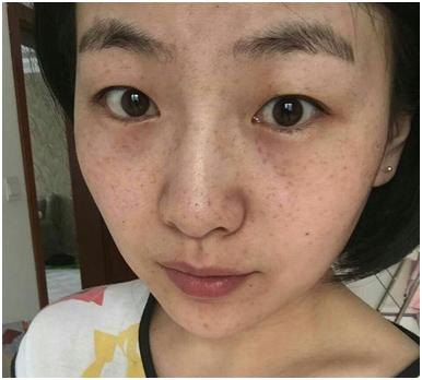 4种被医生拉入黑名单的食物,常吃不亚于“毁容”,还会长斑