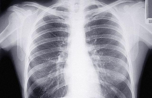 新冠肺炎引发的深思：我们每个人都应该学会养肺，做好以下６点！
