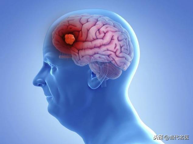 “头部"有4异常，说明脑血管"堵塞"严重，防脑梗，做好“5控"