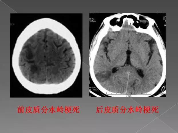 缺血性、出血性、分水岭、腔隙性四大类脑梗的影像区别