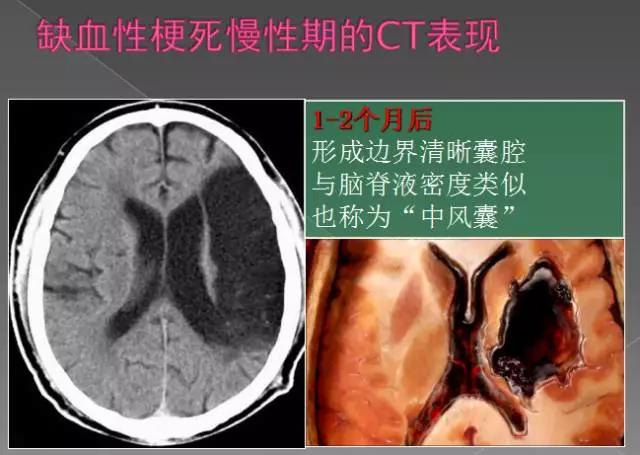 缺血性、出血性、分水岭、腔隙性四大类脑梗的影像区别