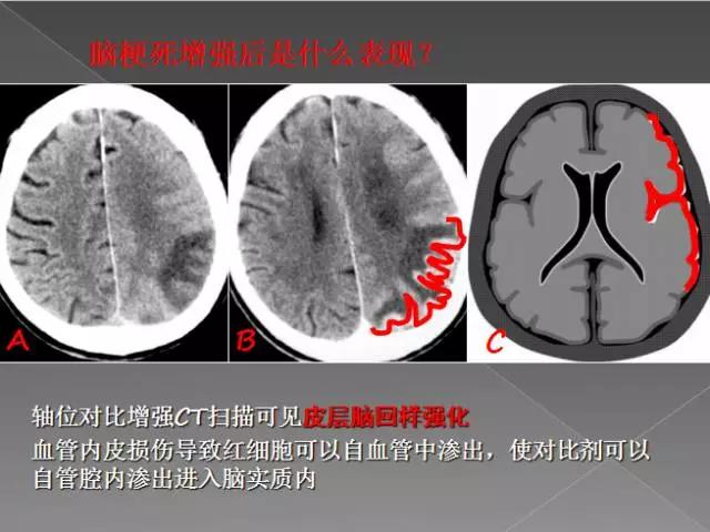 缺血性、出血性、分水岭、腔隙性四大类脑梗的影像区别