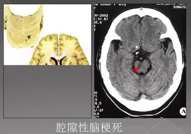 缺血性、出血性、分水岭、腔隙性四大类脑梗的影像区别
