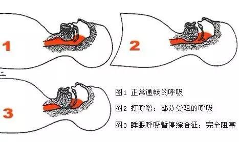 高血压患者睡眠不好,会造成血压不稳定,建议家有高血压的人看看