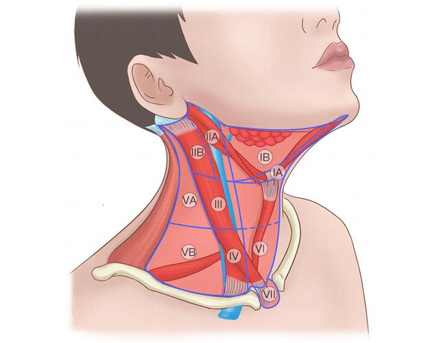 甲状腺患者什么情况要做颈部淋巴结清扫术？颈部淋巴结清扫怎么做