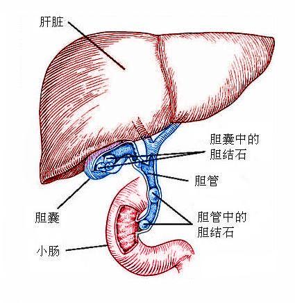 得了胆结石应该怎么办？