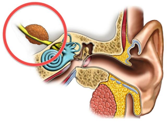 听神经瘤导致的耳鸣，比起平常的耳鸣有什么特点？