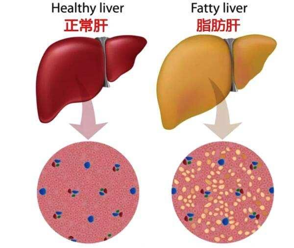 肝脏功能减退，血糖不易稳定！糖尿病与脂肪肝啥关系？了解一下