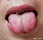 舌诊怎么看，看下脏腑衰退和脾肾阳虚的舌头