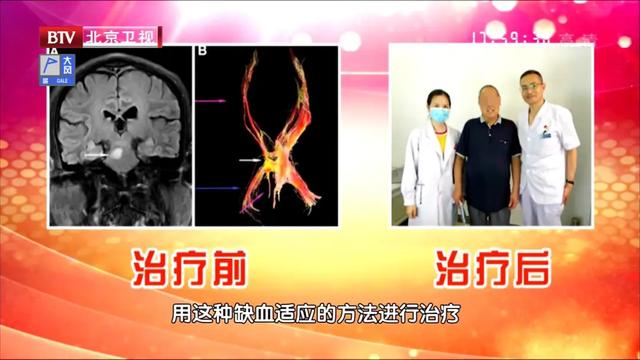 血管最怕堵!常做三个小动作,护血管、促循环,预防卒中和痴呆