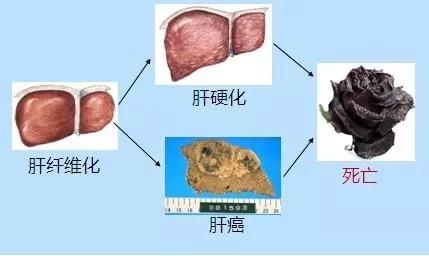 【提醒】生活中容易导致肝纤维化的因素，请多注意！