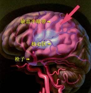 脑梗后能完全恢复正常吗?医生:有可能,但需要满足这3点