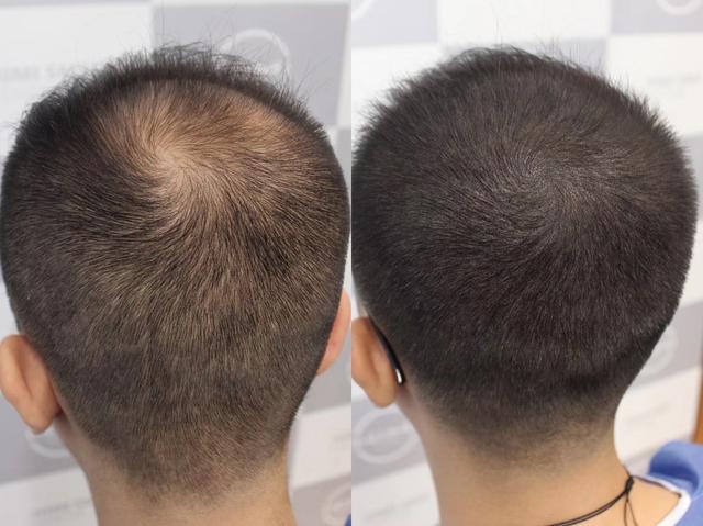 人到中年30岁后男人如何预防改善脱发?