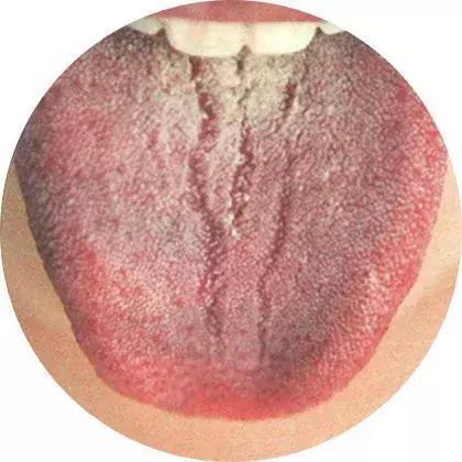舌苔中反映的身体信息