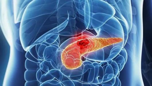胰腺癌的"导火索"主要有这3个，血脂高排第一，早知道，或能及早消除隐患！