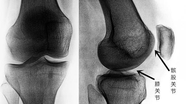 辟谣！膝关节炎常见的三大谣言，你是否也一直这样操作？