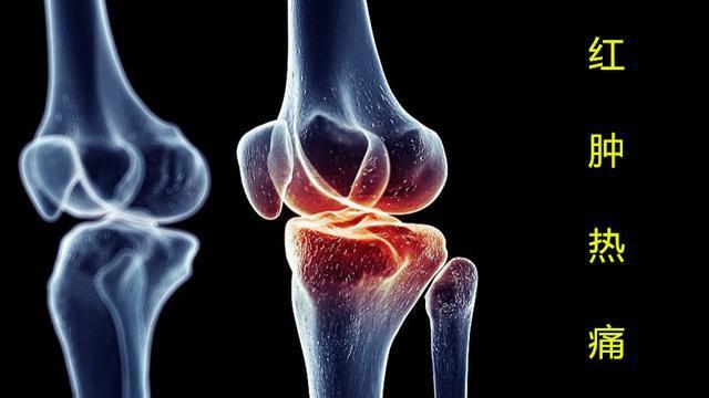 辟谣！膝关节炎常见的三大谣言，你是否也一直这样操作？