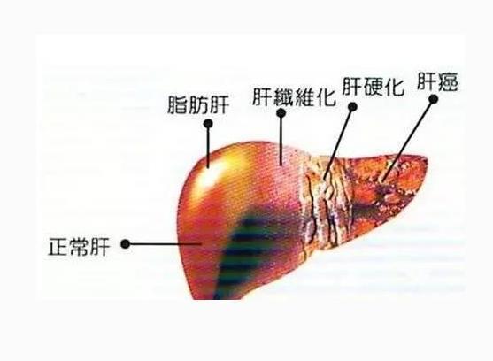 3个坏习惯最伤肝,医生:肝功能异常有9个表现,要及时检查