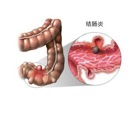 肠道有炎症，大便不成形？这3种表现提示该做2项检查了，你有么？